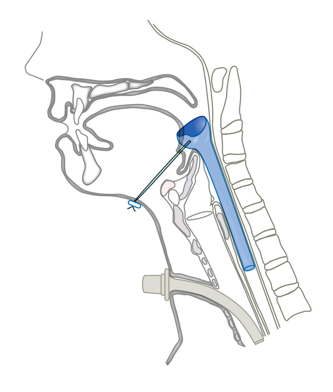 Har-El Pharynx Speichel-Bypass-Tubus
