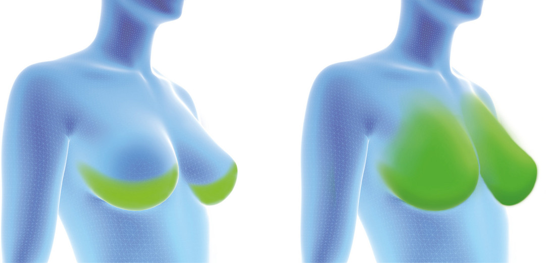 Fortiva® für die Brustrekonstruktion Fortiva® für die Brustrekonstruktion