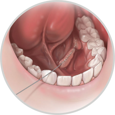 Führungsdraht Führungsdraht