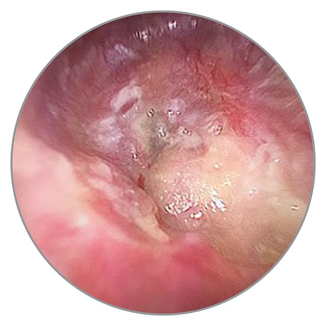 15 Tage nach der OP 15 Tage nach der OP