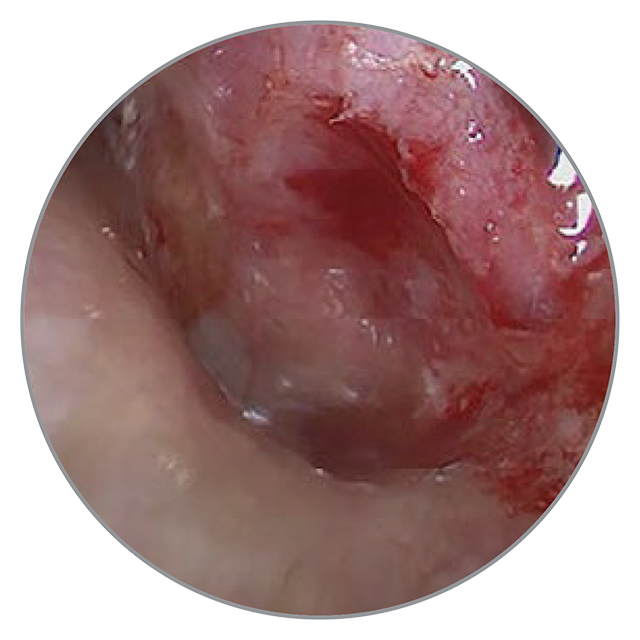 40 Tage nach der OP 40 Tage nach der OP