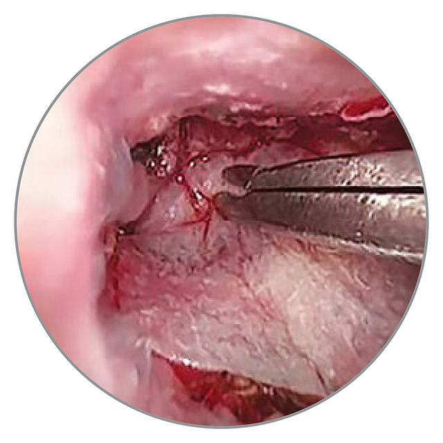 Platzierung des Biodesign® Implantats Platzierung des Biodesign® Implantats